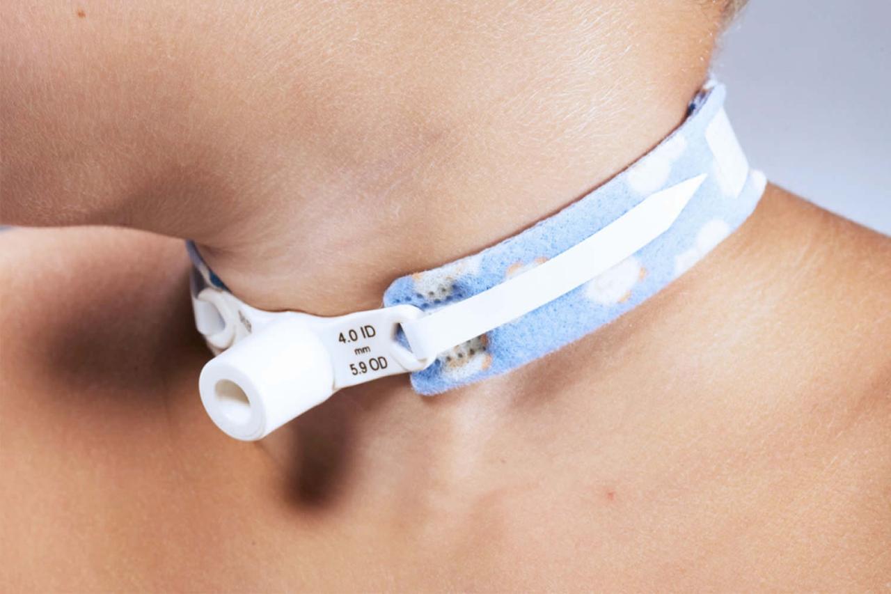 Tracheostomy - NHS Ways To Wear Athleisure In Casual Settings